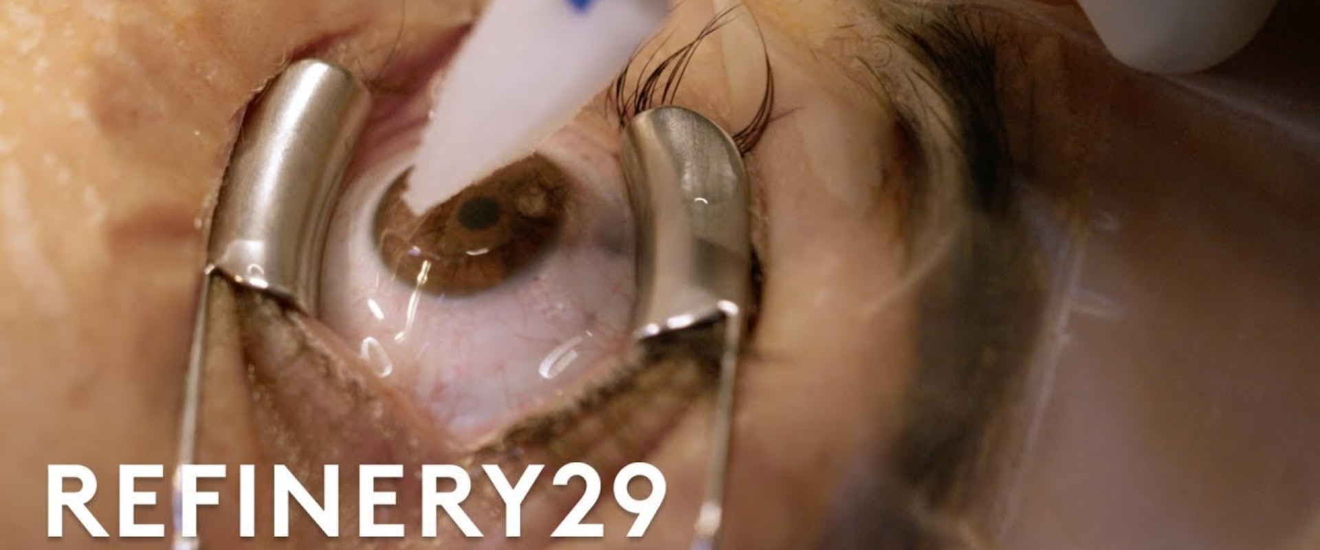 Is Laser Eye Surgery Permanent? A Comprehensive Guide to Lasting Vision