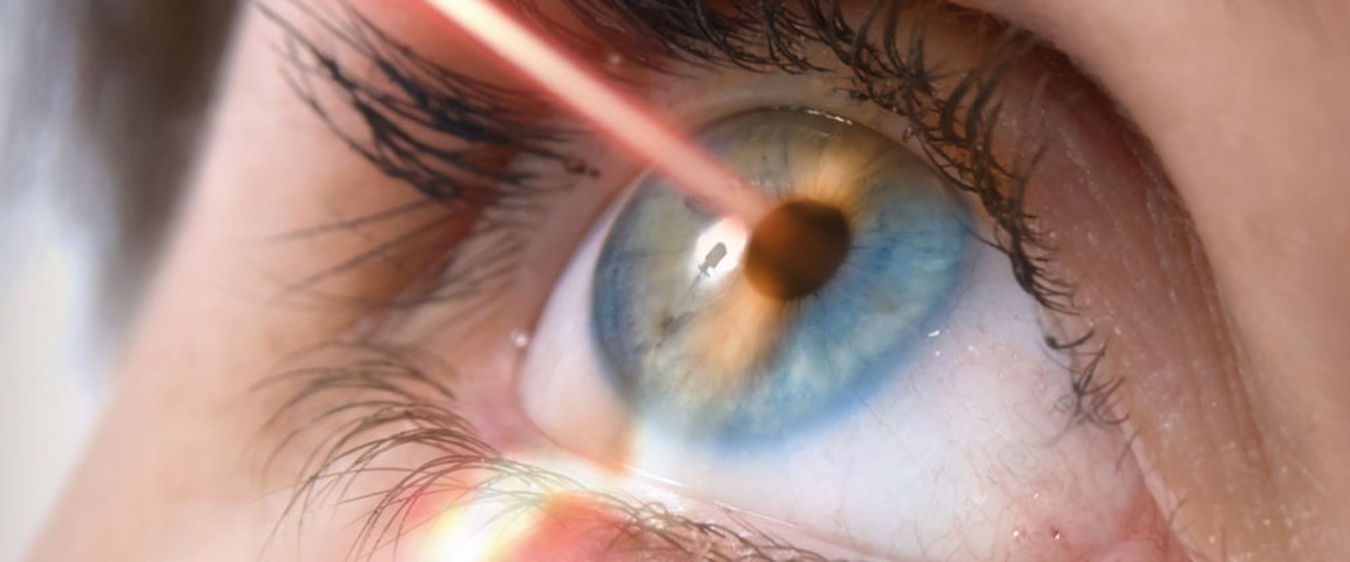 What are the Disadvantages of Laser Eye Surgery?