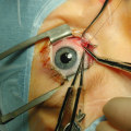 Is Laser Eye Surgery a Good Idea?