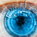 Does Laser Eye Surgery Last Forever?