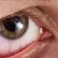 Can You Have LASIK Surgery with Dry Eyes?