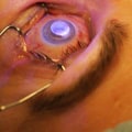What Are the Risks of LASIK Eye Surgery?