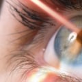 Unlock the Benefits of Laser Eye Surgery: A Comprehensive Guide
