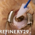 Everything You Need to Know About Laser Eye Surgery