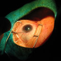 Is LASIK OK After 50?