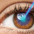 Does Laser Eye Surgery Permanently Fix Eyesight?