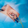 What Precautions Should You Take After Laser Eye Surgery?