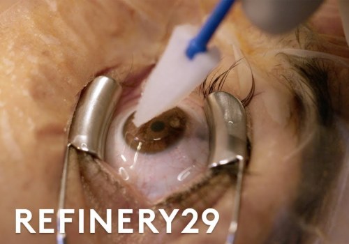 Is Laser Eye Surgery Permanent? A Comprehensive Guide to Lasting Vision