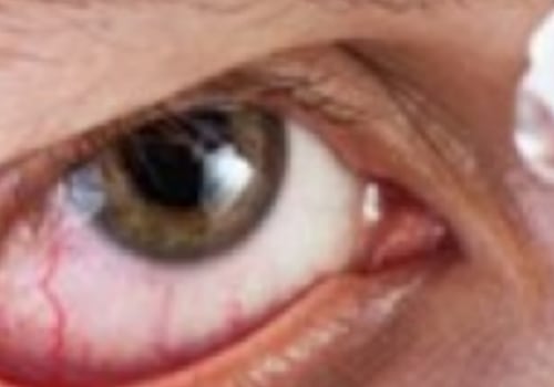 Can You Have LASIK Surgery with Dry Eyes?