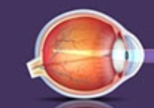 Can You Get Laser Eye Surgery with Astigmatism and Myopia?