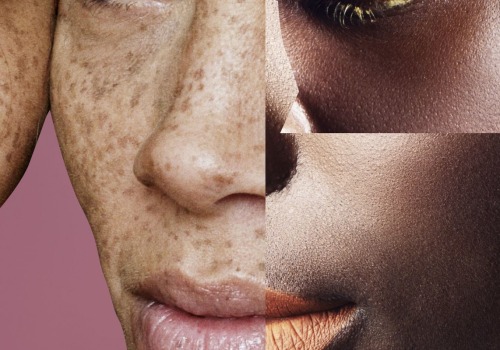 Laser Eye Surgery on Dark Skin: Considerations and Treatments